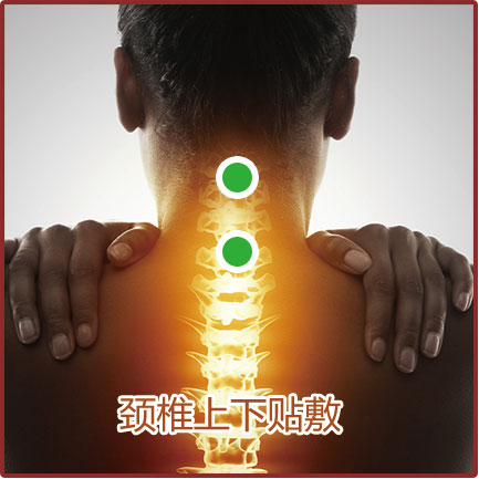 神經(jīng)根型、脊髓型頸椎病貼敷位置示意圖